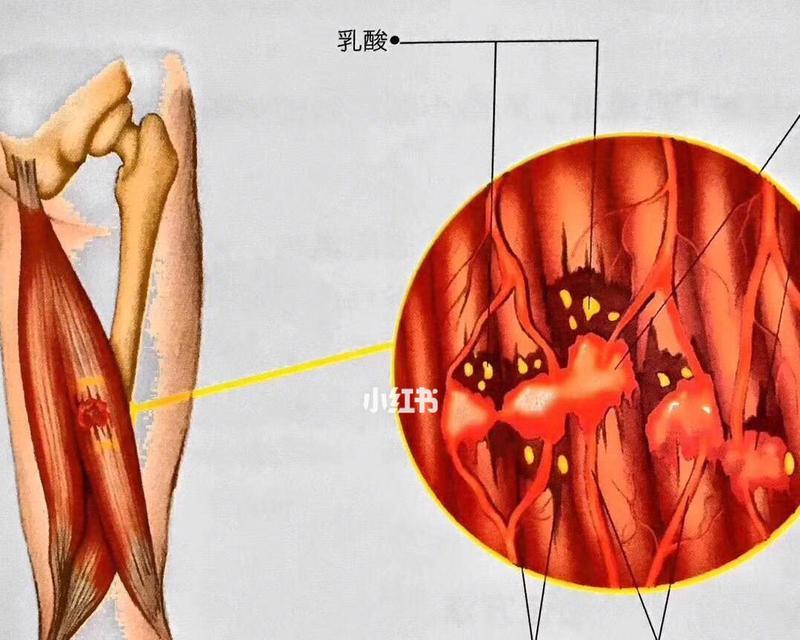 肌肉酸痛（了解肌肉酸痛的成因）